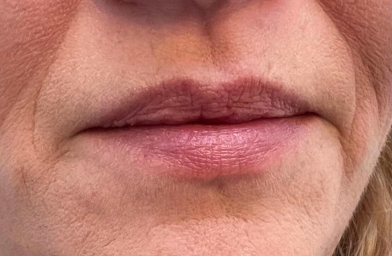 Lippen vóór de behandeling