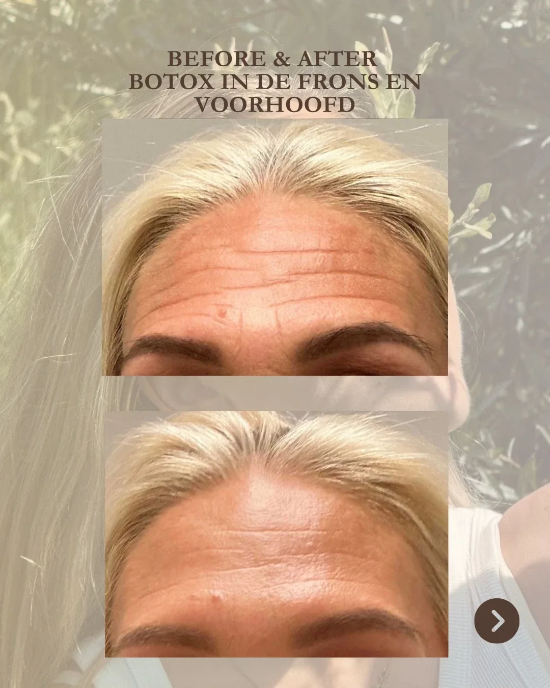 Frons en voorhoofd vóór de behandeling